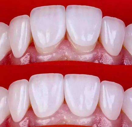 瓷雕美牙：恢复笑容的选择