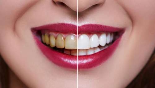 瓷贴面拆除后，牙齿是否能够恢复正常使用？