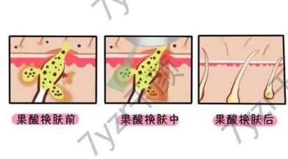 激光祛斑有什么原理，有哪些注意事项?