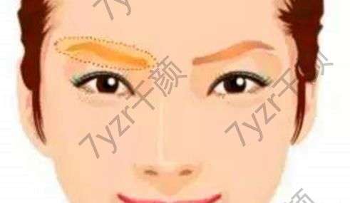 影响假体垫眉弓手术的安全性的因素有哪些