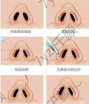 鼻孔缩小手术失败可以修复吗?